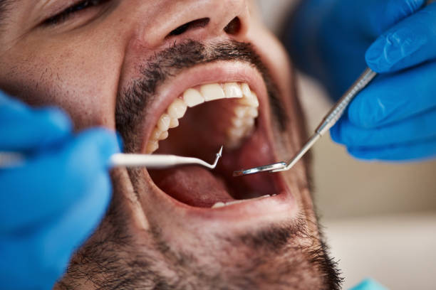 Best Emergency Tooth Extraction in Linton Hall, VA