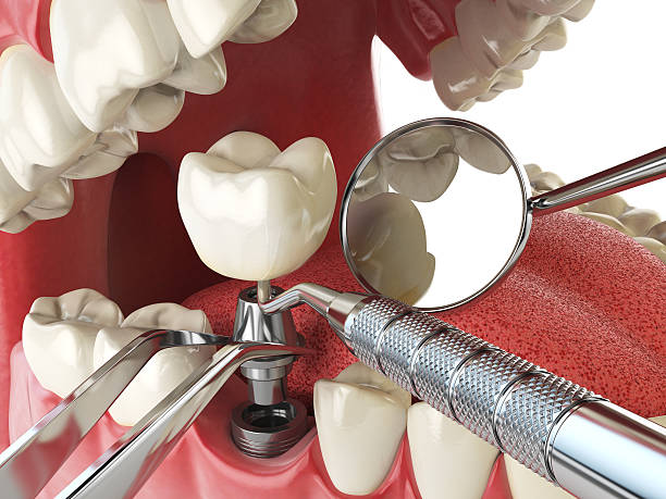 Best Emergency Dental Care for Broken or Chipped Teeth in Linton Hall, VA